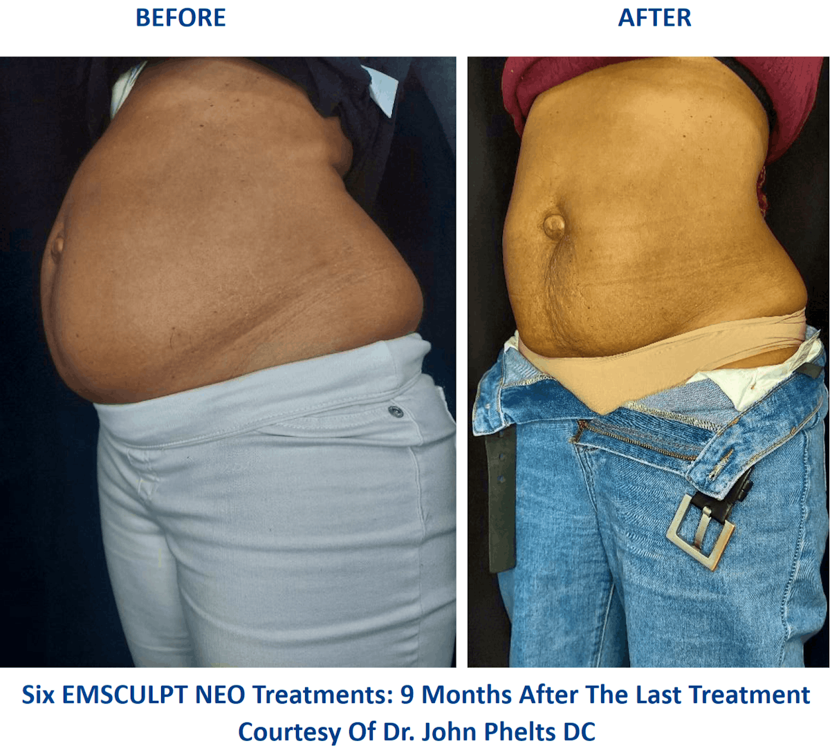 EMSCULPT NEO Before and After Cost