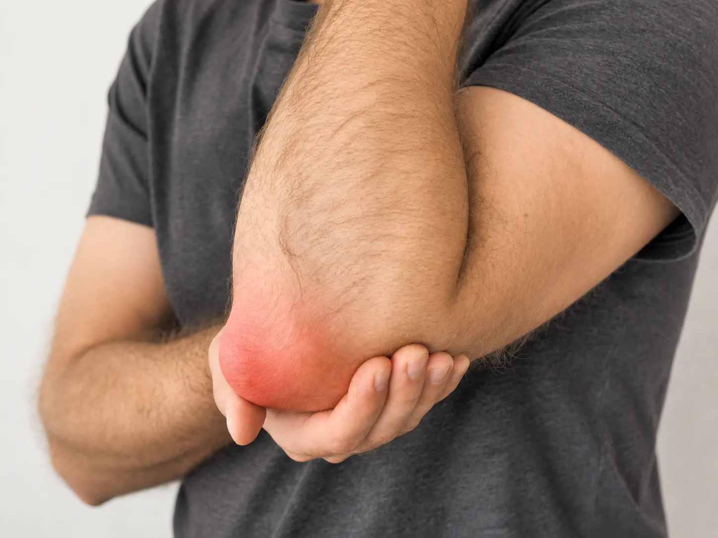 Man holding a swollen and painful elbow with visible olecranon bursitis inflammation