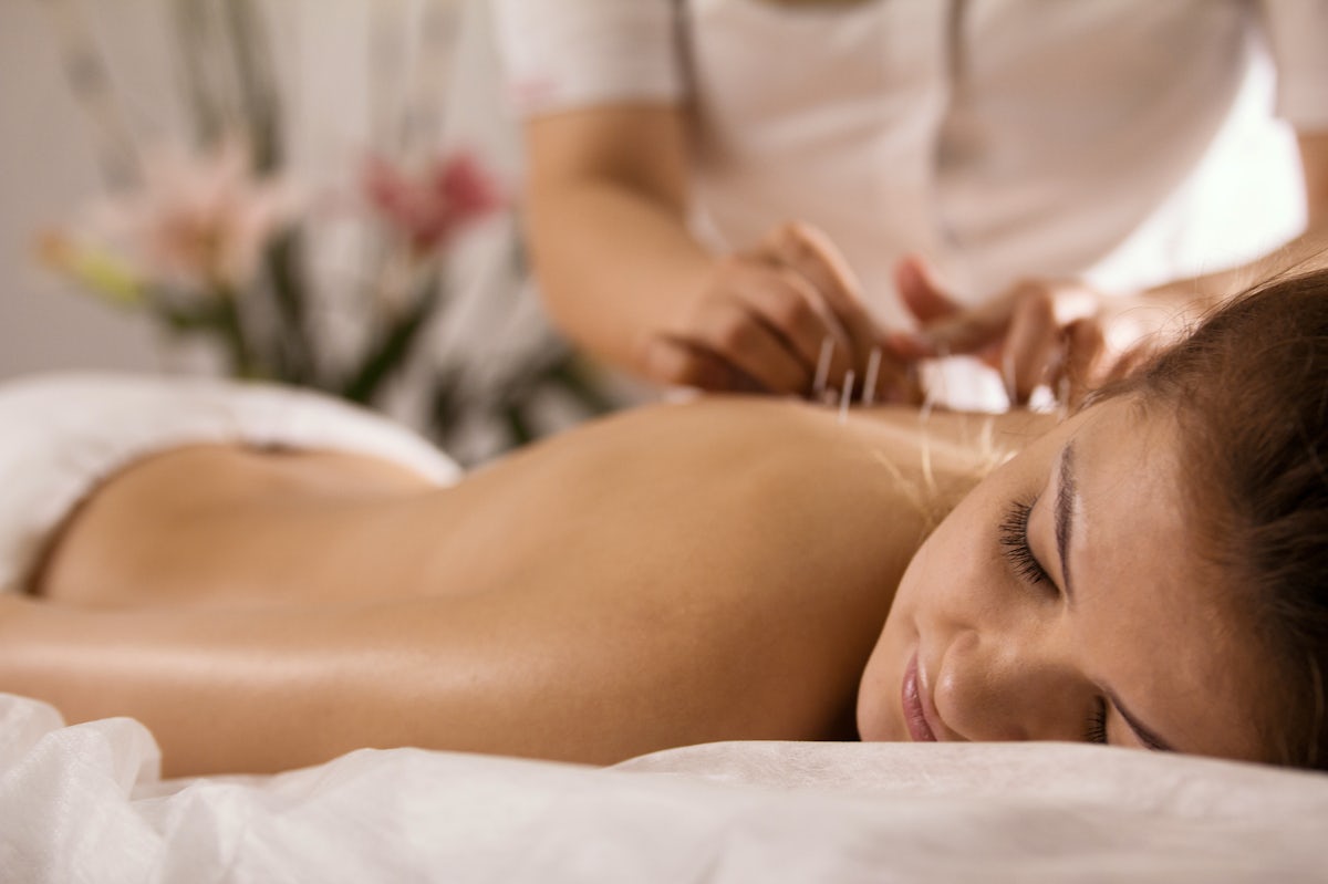 The image shows a person receiving acupuncture treatment, lying on a table with needles inserted in their back, in a calming, spa-like environment.