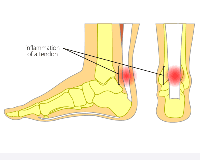 medical illustration showing the side and back view of a foot and ankle highlighting inflammation of the achilles tendon with red shading