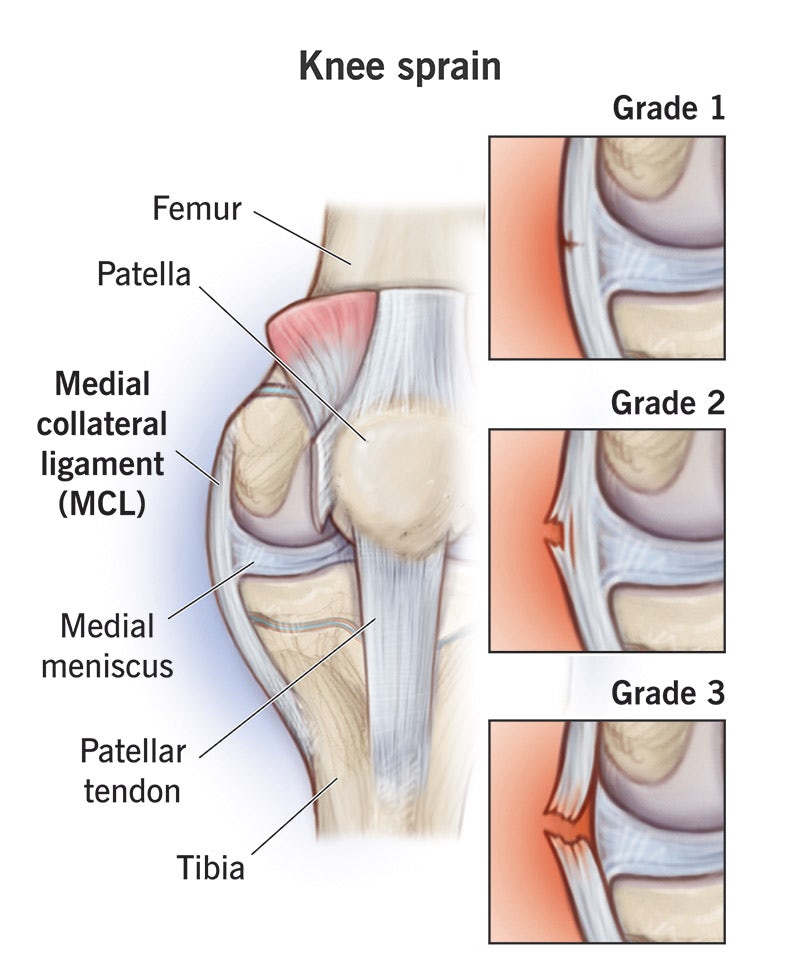 Medical illustration of a knee sprain showing the medial collateral ligament (MCL) with Grade 1, Grade 2, and Grade 3 ligament tears.