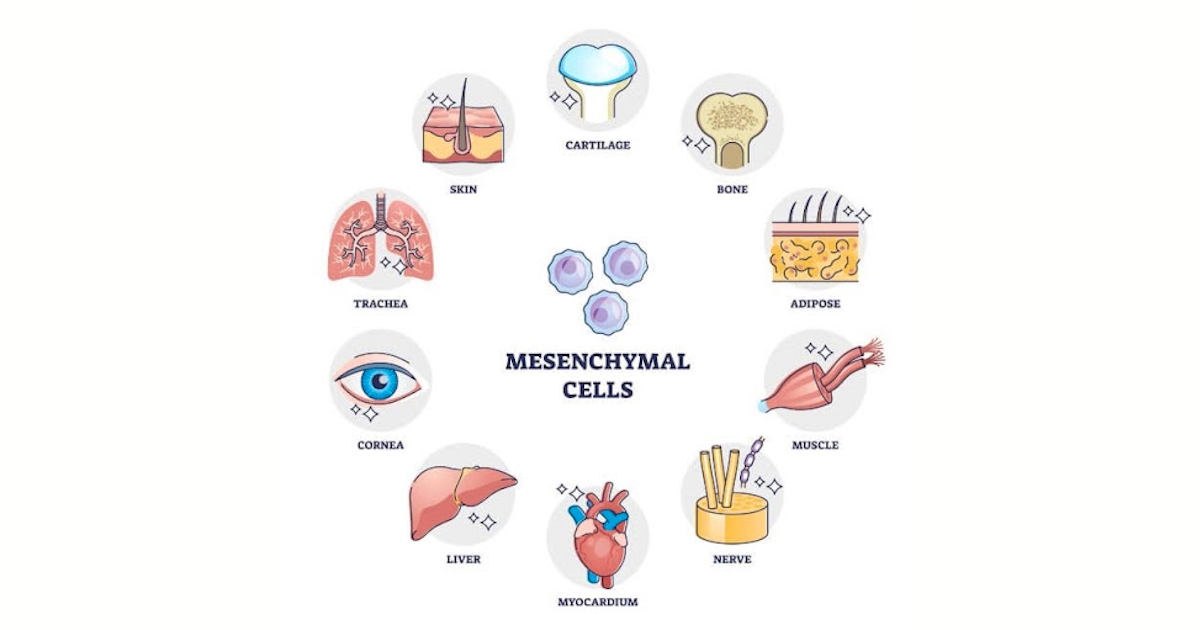  Mesenchymal Stem Cells (MSCs), Aloha, OR