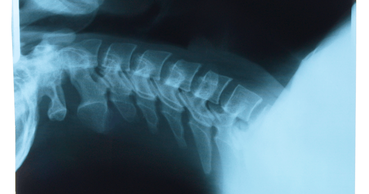 The image shows an X-ray of a human spine, highlighting the vertebrae and surrounding structures along the spinal column.