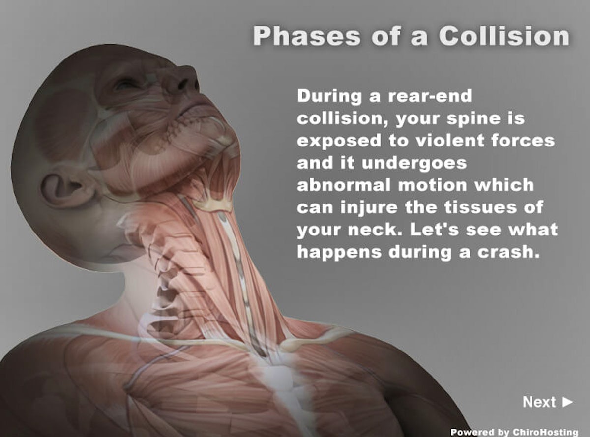 During a rear-end collision, your spine is exposed to violent forces and it undergoes abnormal motion which can injure the tissues of your neck. Let's see what happens during a crash.