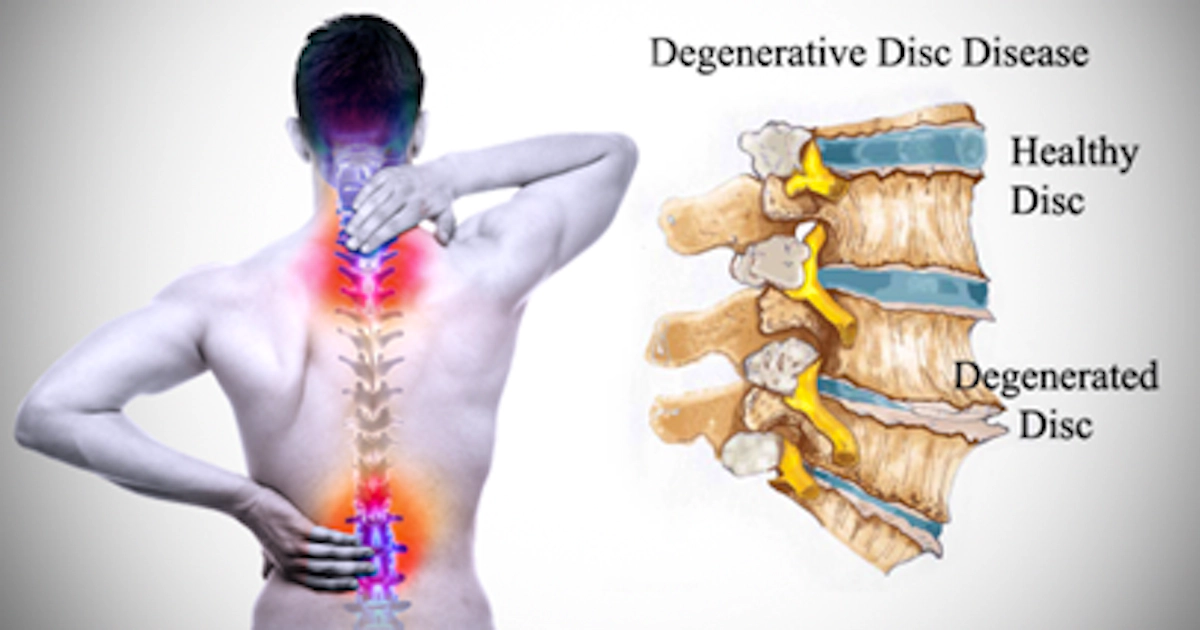 How Do I Know If I Have Disc Disease? Signs and Solutions from Your ...