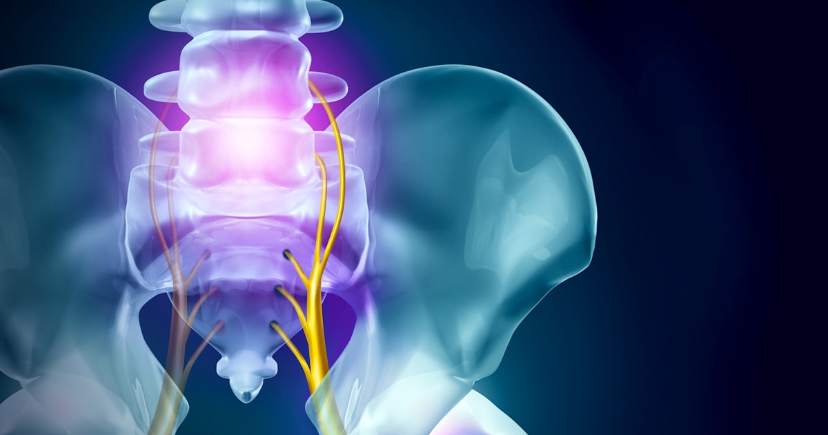 Sciatica Pain