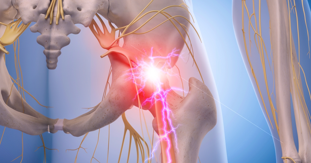 medical illustration of inflamed sciatic nerve