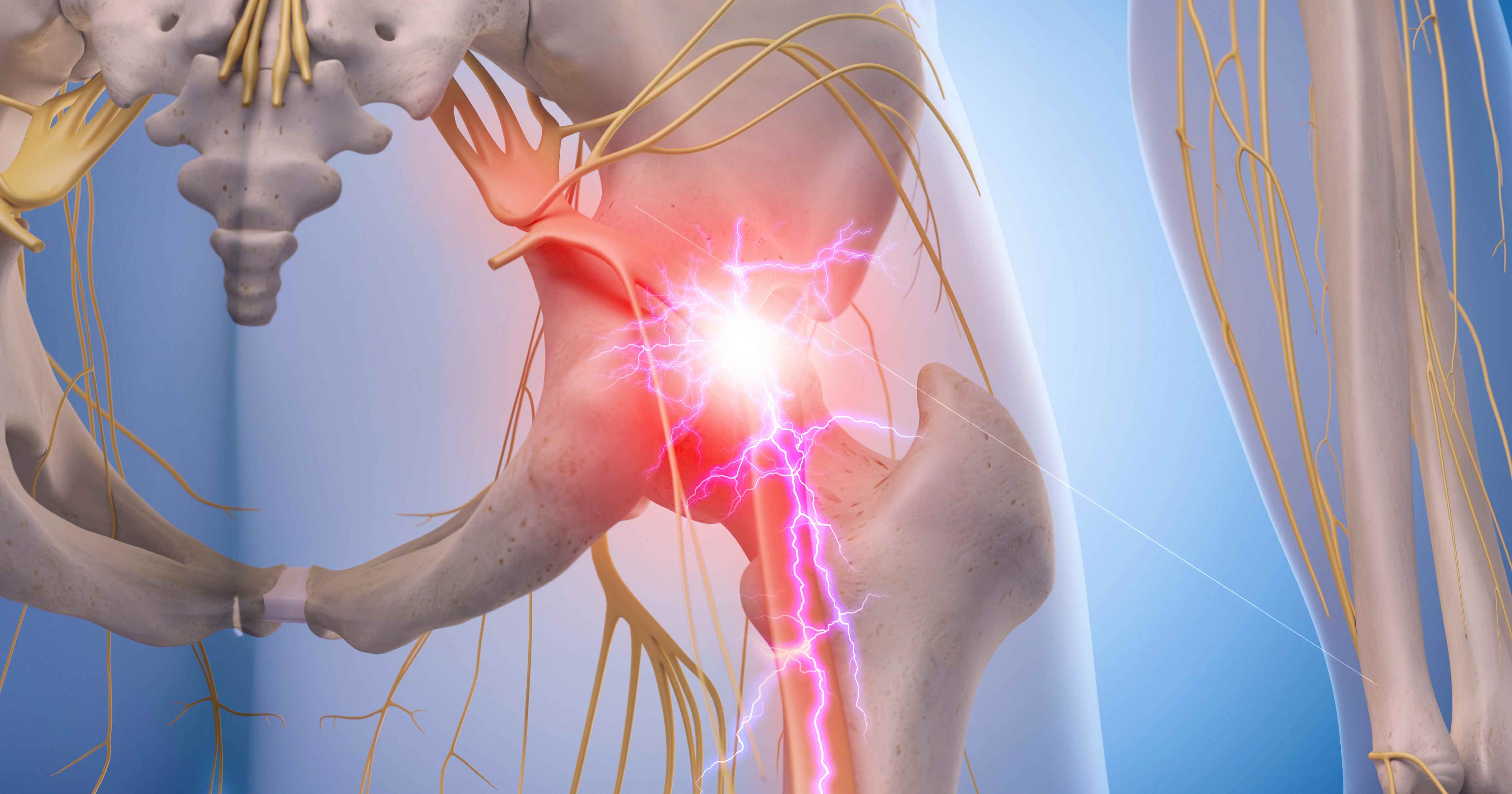 Симптомы боли седалищного нерва у мужчин. Тазобедренный сустав седалищный нерв. Ишиас воспаление седалищного. Защемление седалищного нерва.
