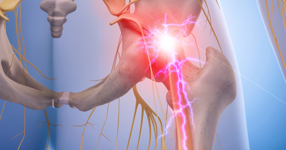 medical illustration of inflamed sciatic nerve