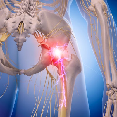 medical illustration of inflamed sciatic nerve
