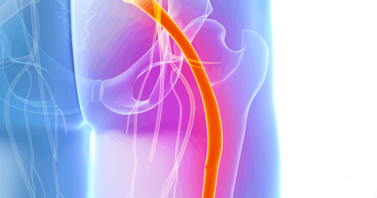 painful sciatic nerve