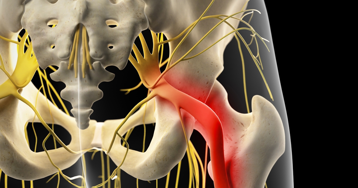 painful sciatic nerve