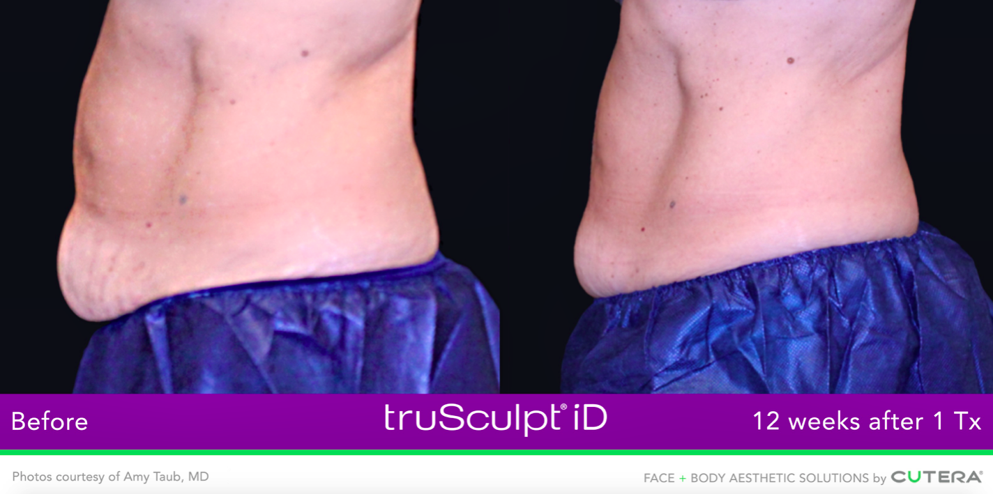 before & after trusculpt