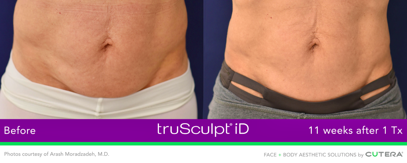 before & after trusculpt