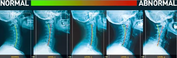 Cervical spine x-ray comparison showing normal through abnormal cervical curve examples