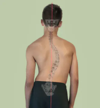 Back view showing a scoliosis curve and spinal asymmetry