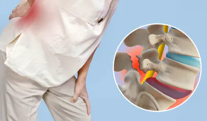 Person with lower back pain and illustration showing vertebral slippage associated with spondylolisthesis