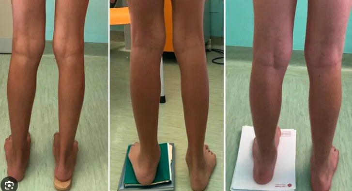Comparison of lower limb alignment and pelvic position when assessing leg length discrepancy