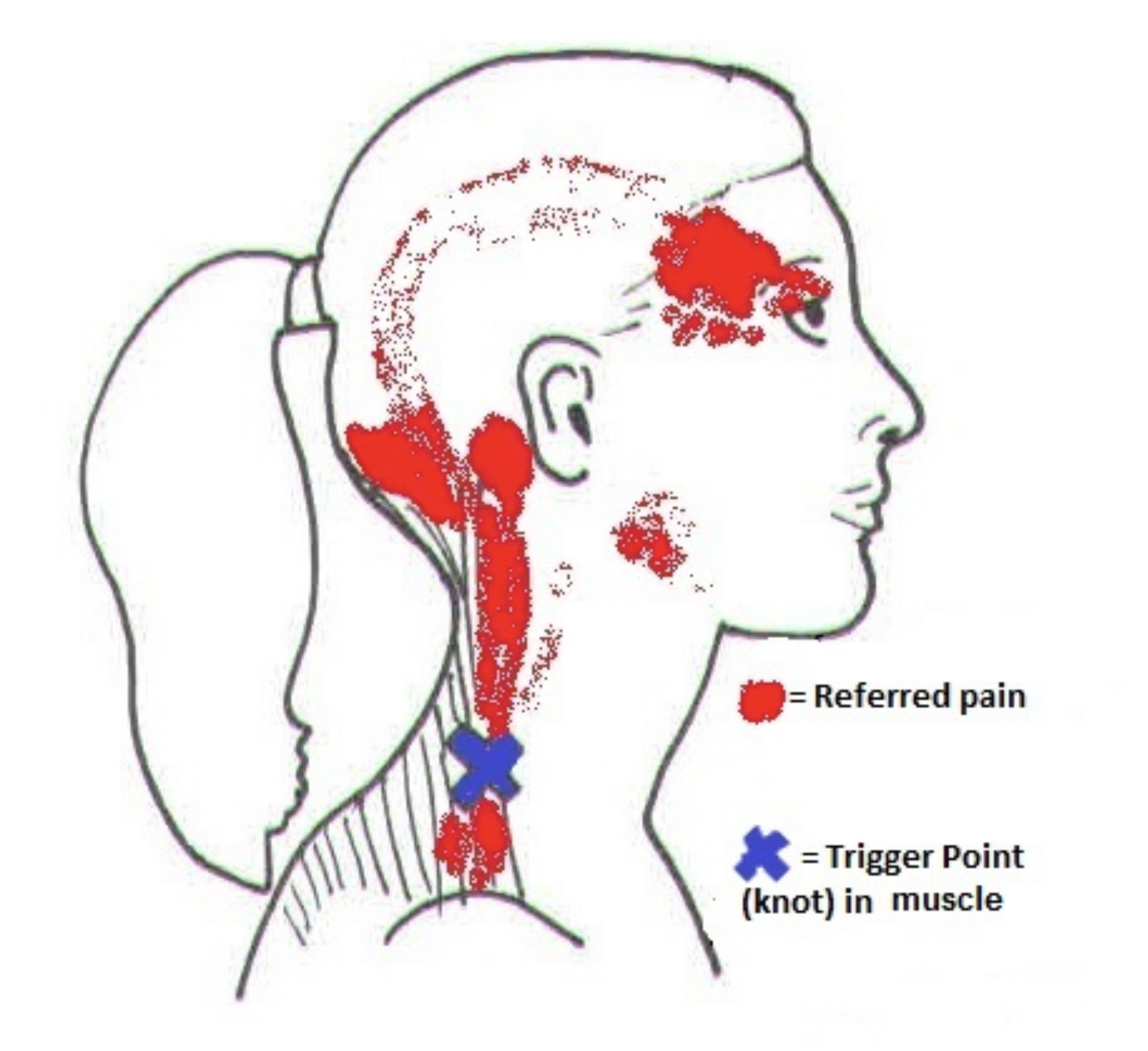 Neck pain and headache assessment at chiropractor in Oakleigh and surrounding suburbs