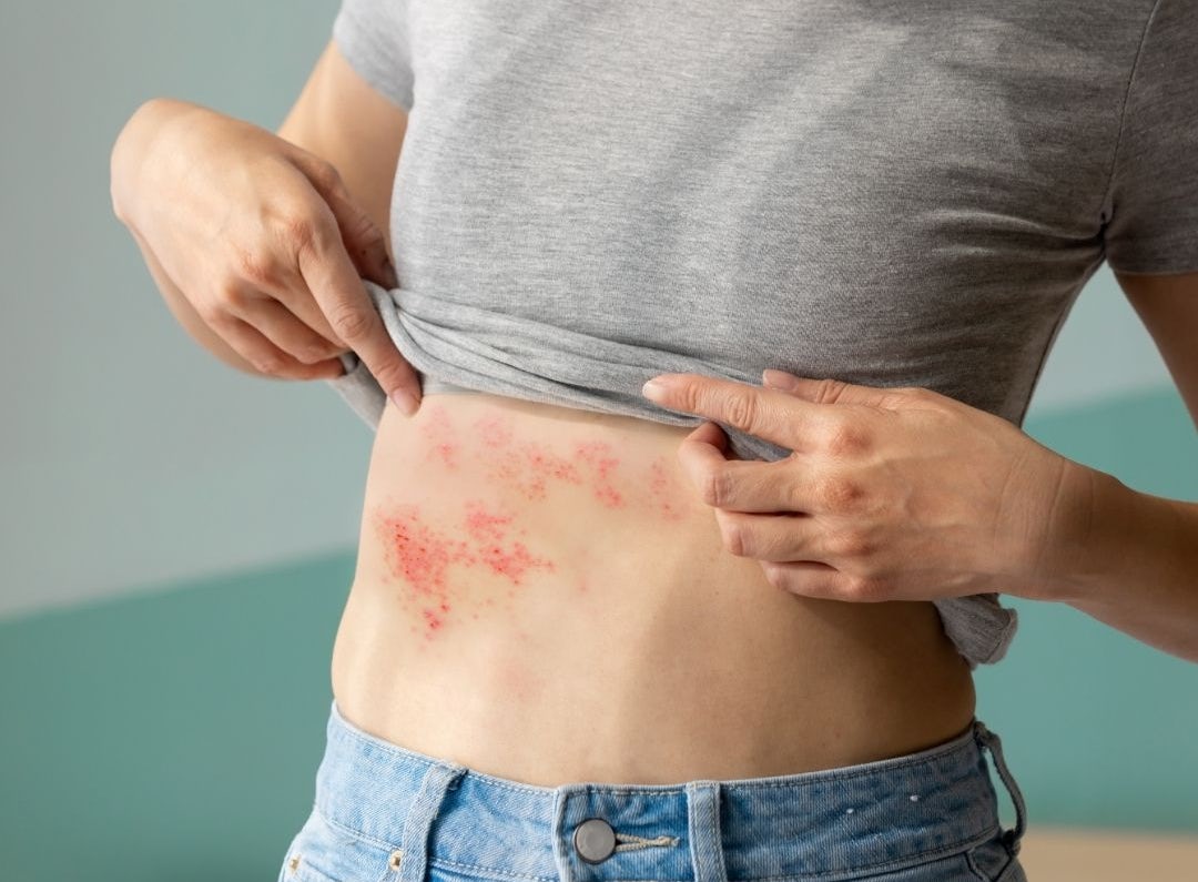 Person lifting gray T-shirt to reveal red shingles rash across the right side of the abdomen near the waist.