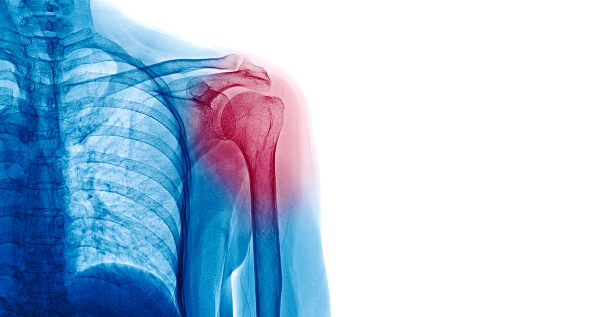 X Ray image of patient who have shoulder pain isol