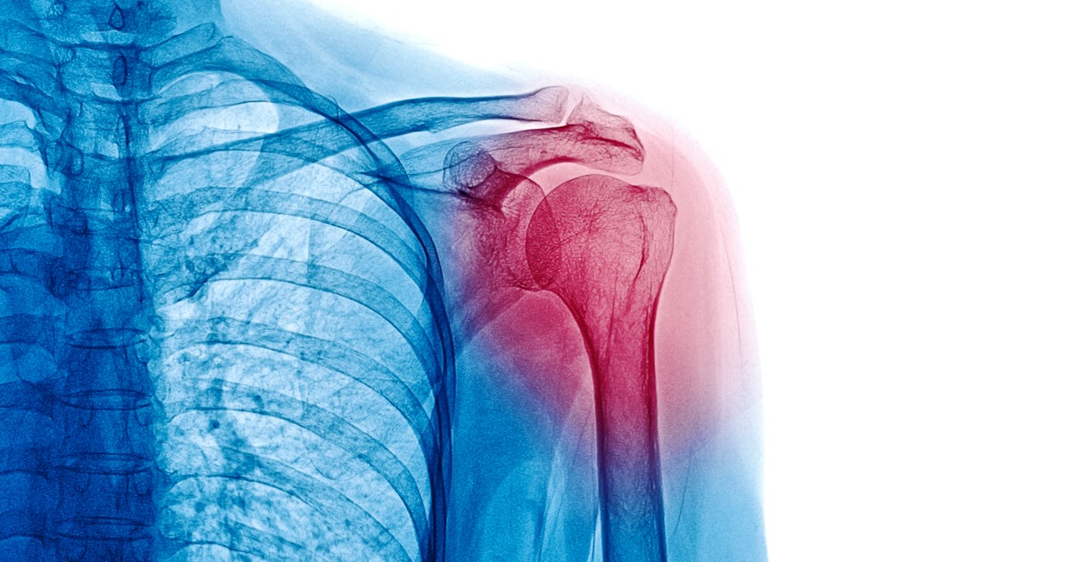 X Ray image of patient who have shoulder pain isol