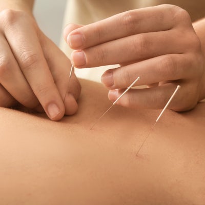 up close of young man getting acupuncture in the middle of his back