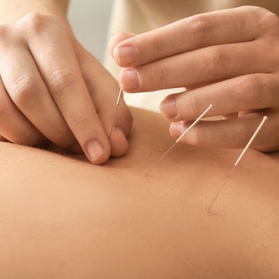 up close of young man getting acupuncture in the middle of his back