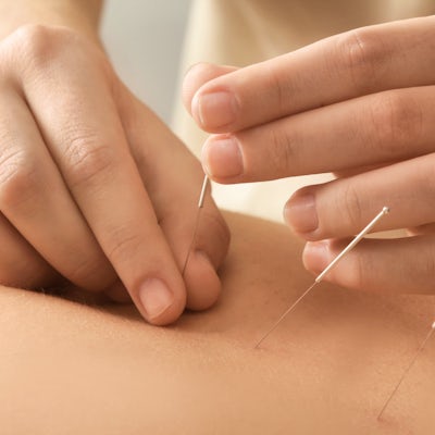 up close of young man getting acupuncture in the middle of his back
