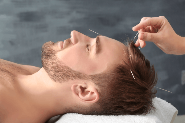 up close left side of face of young white man getting acupuncture in the top of his head