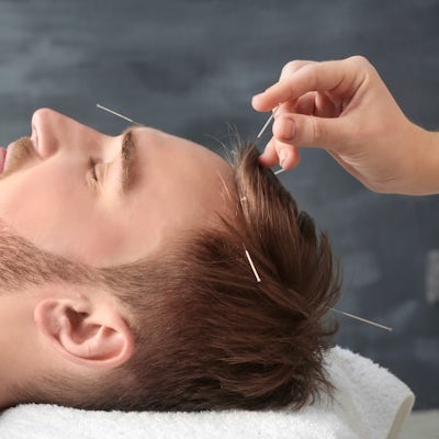 up close left side of face of young white man getting acupuncture in the top of his head