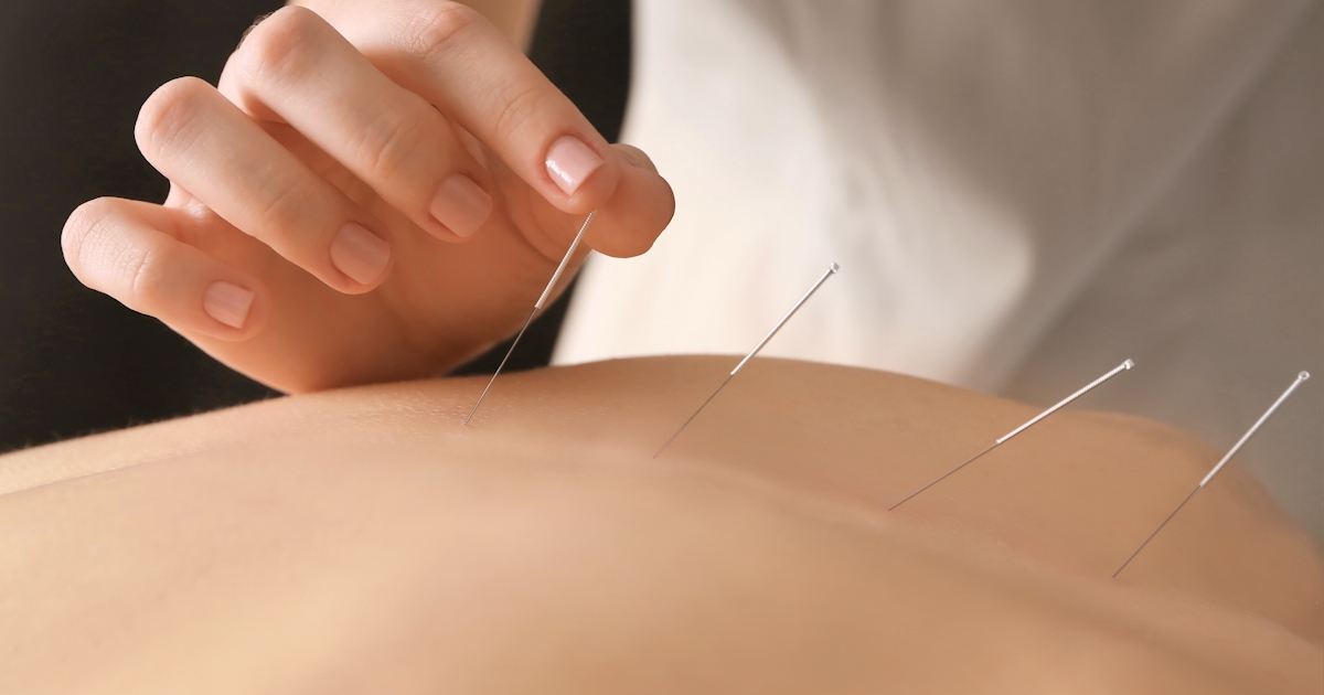 up close of the top of the back of white female getting acupuncture by female acupuncturist