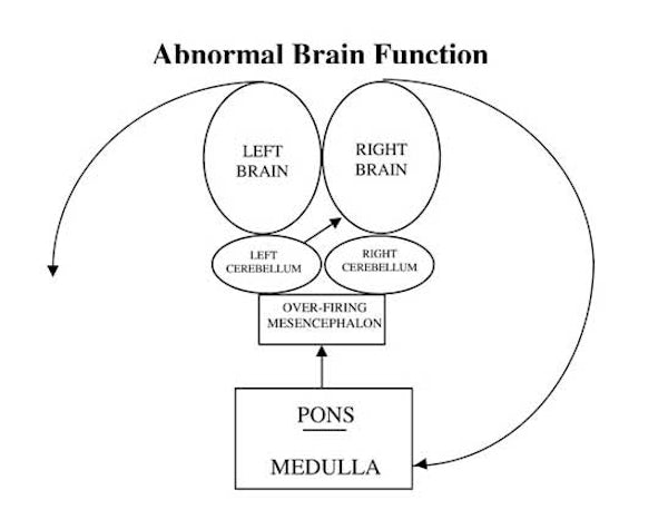 abnormal brain firing