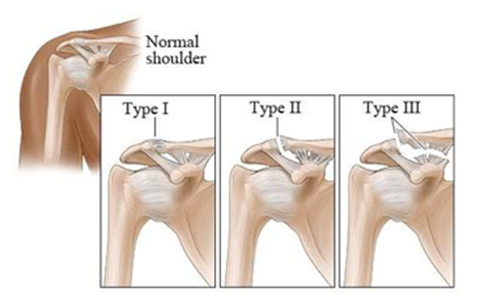 Acromioclavicular/shoulder Joint Sprain- Low level laser/cold laser Perth, Joondalup , WA Pain Management