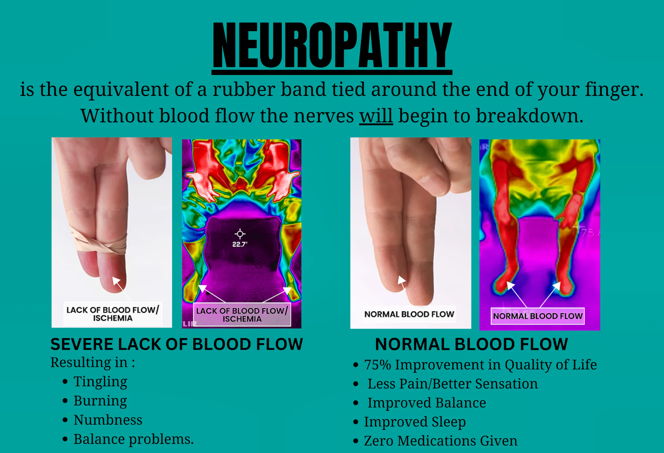 Neuropathy educational graphic comparing reduced and normal blood flow