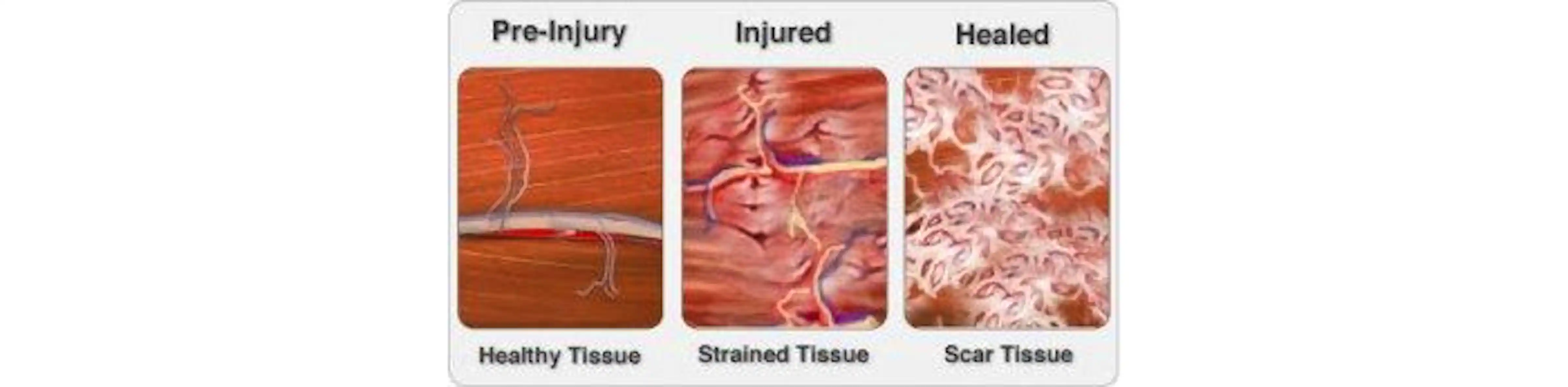 Everything You Need to Know About Scar Tissue | Gnangara, WA Pain ...
