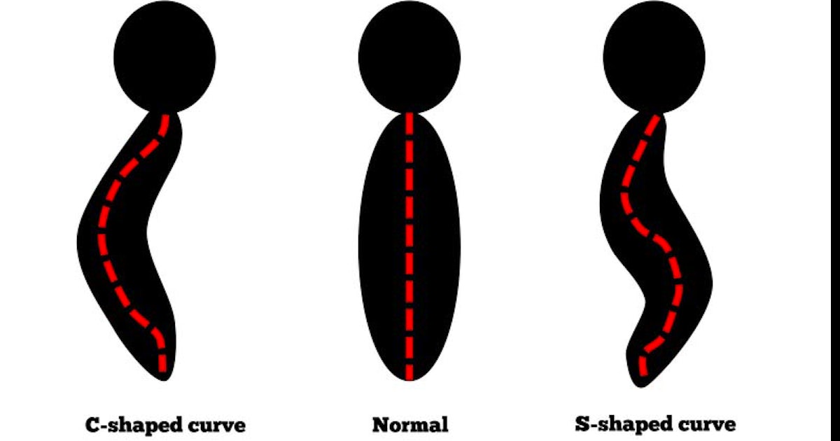 Diagram of three spine shapes: C-shaped curve, Normal, and S-shaped curve