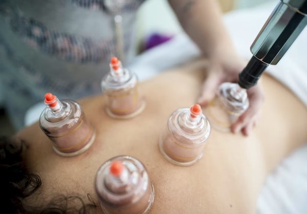 cupping