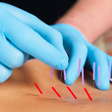 Dry Needling