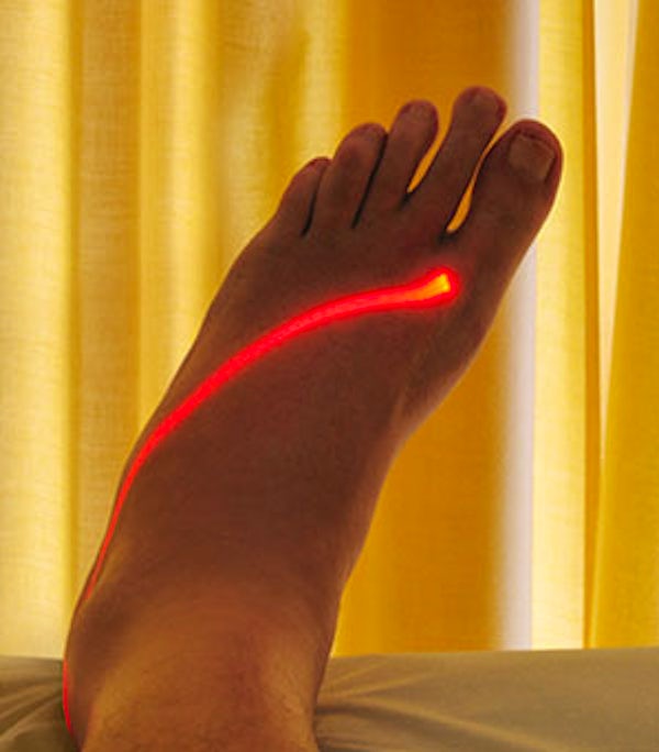 foot-laser-therapy