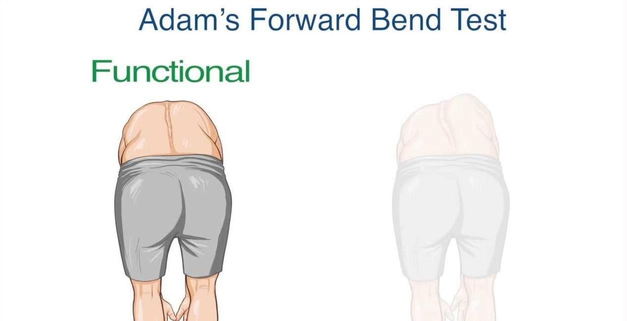 Adam's Forward Bend Test for scoliosis