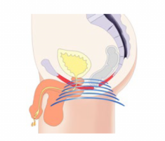 EMSELLA For Men Prostate and Erectile Health