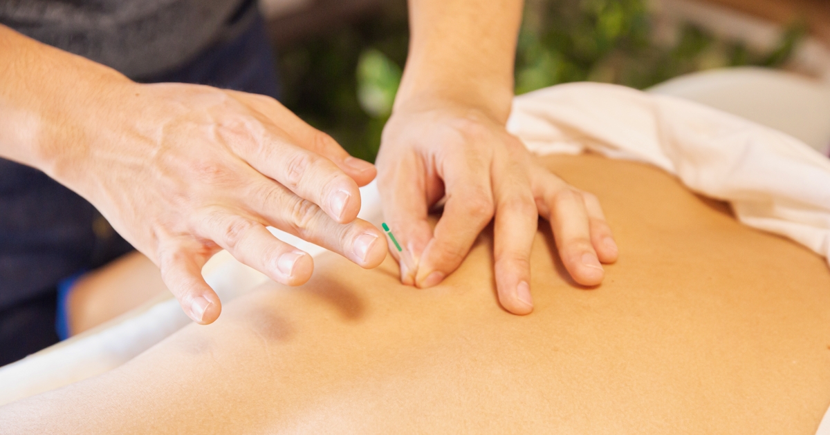 acupuncture