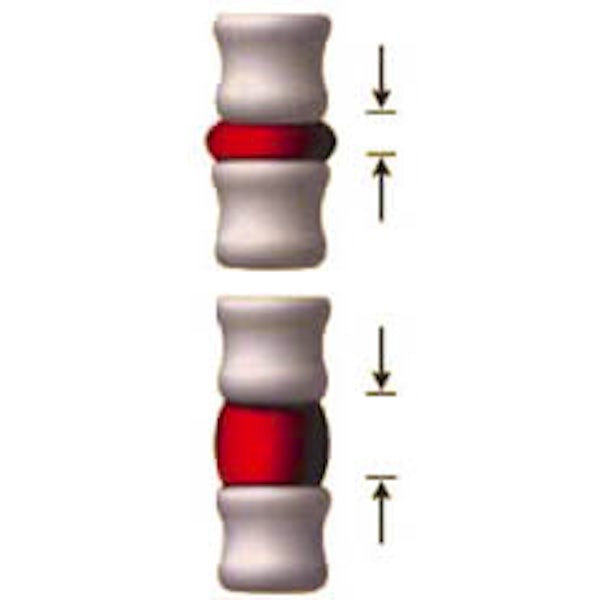 spine pressure