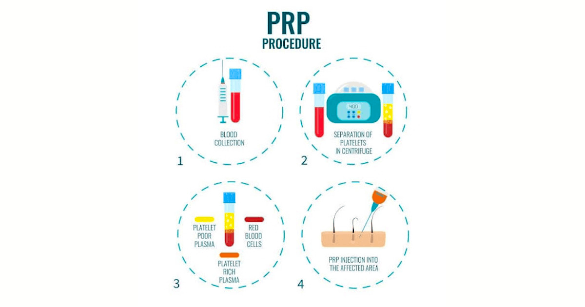 Illustration of PRP procedure done at Oregon medical centers in Aloha & Salem