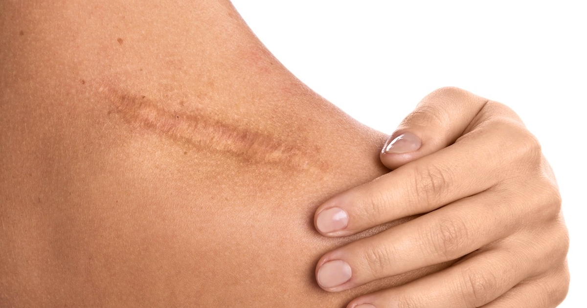 Everything you need to know about scar tissue, Joondalup , WA Pain  Management