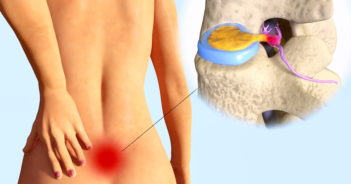 The image shows a human back with highlighted pain areas and an inset illustration of a spinal disc possibly herniated, affecting nerves.