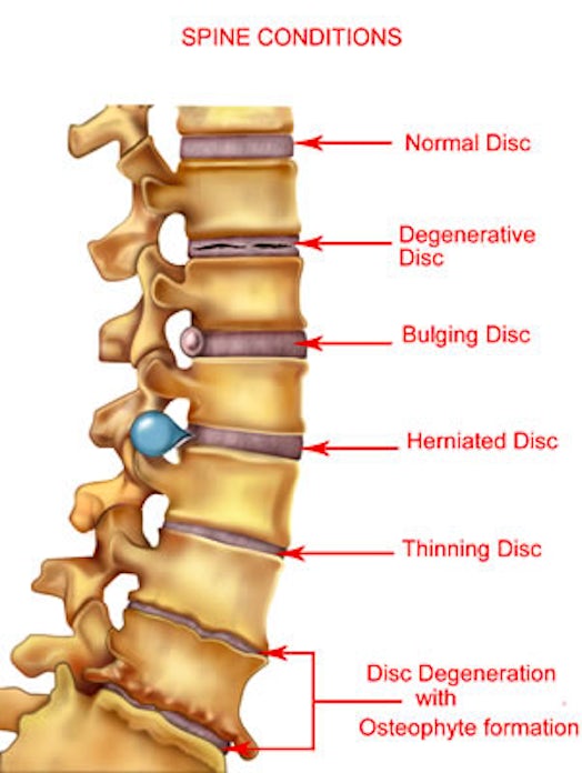  spine conditions