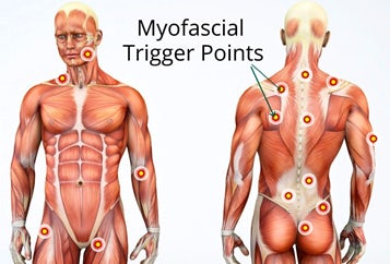 trigger point chart