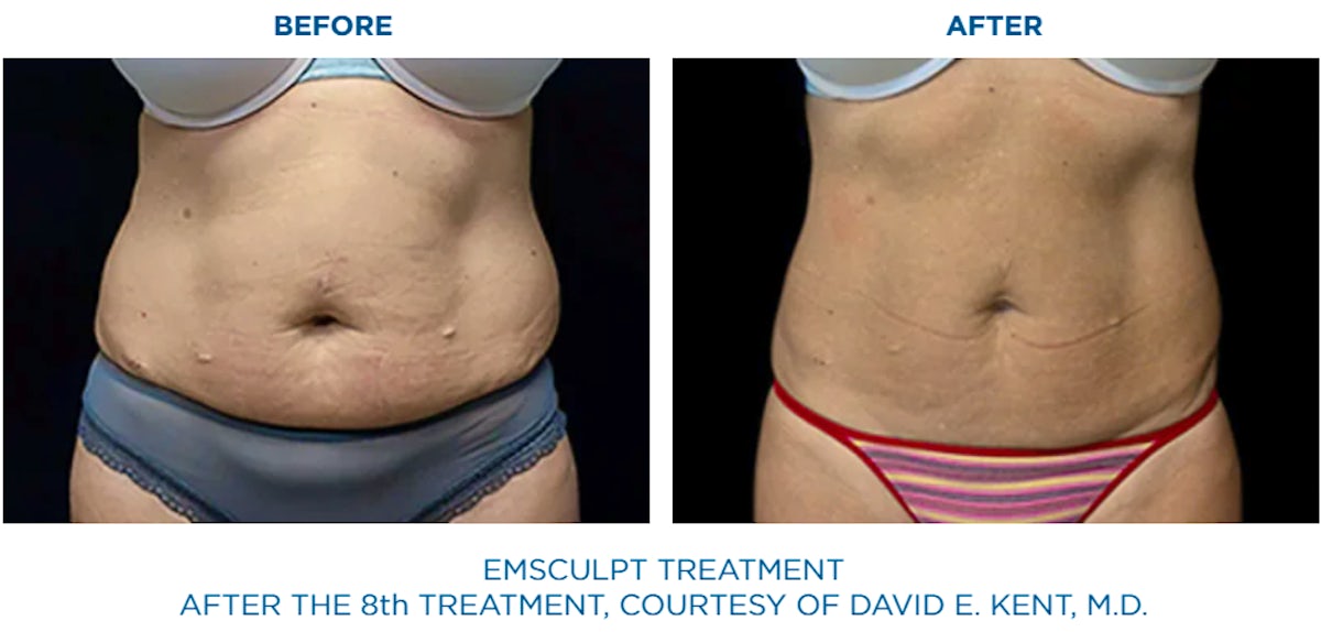 shape and contour body